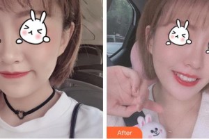 上海市皮膚病醫(yī)院醫(yī)療美容科王娜整形價(jià)格表附光子嫩膚案例展示