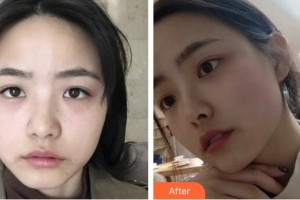 上海光博士醫(yī)療美容門(mén)診部張健整形價(jià)格表附超激光美膚祛雀斑曬斑案例展示