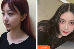 廣州番禺陽光整形美容醫(yī)院易東風整形價格表附隆鼻案例展示