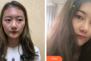 廣州美恩整形美容醫(yī)院周三民整形價格表附肋軟骨隆鼻案例展示