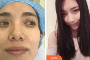 廣州美恩整形美容醫(yī)院王才仁整形價格表附小氣泡單次體驗案例展示