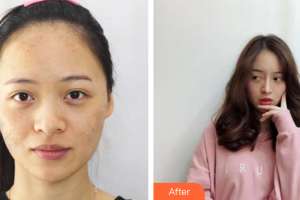 廣州解放軍第四五八醫(yī)院激光整形美容中心陳柯整形價格表附激光美膚激光祛斑案例展示