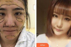 上海復(fù)麗醫(yī)療美容門(mén)診部鄭佳瑋整形價(jià)格表附自體脂肪案例展示