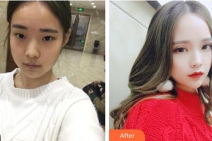 上海楊思醫(yī)院醫(yī)學(xué)美容科巴友良整形價(jià)格表附眼部手術(shù)案例展示