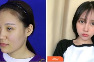 上海俏佳人整形外科門(mén)診部田苗苗整形價(jià)格表附鼻部手術(shù) 面部吸脂案例展示