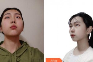 上海凱渥醫(yī)療美容門(mén)診部許心蕾整形價(jià)格表附光子嫩膚案例展示