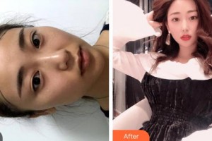 上海WA臻景醫(yī)療美容門(mén)診部徐昌勛整形價(jià)格表附植發(fā)案例展示