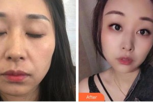 上海WA臻景醫(yī)療美容門診部Linde整形價(jià)格表附面部自體脂肪填充案例展示