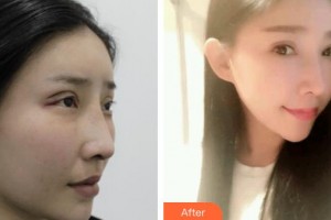 上海WA臻景醫(yī)療美容門(mén)診部KimSam整形價(jià)格表附雙眼皮修復(fù)案例展示