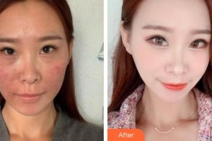 上海瑞東醫(yī)院美容皮膚科周采青整形價(jià)格表附皮膚管理案例展示