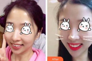 上海瑞東醫(yī)院美容皮膚科劉麗琳整形價(jià)格表附無(wú)針?biāo)獍咐故?>
</a>
<h3 class=