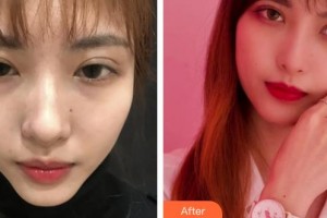 上海解放軍第八五醫(yī)院整形美容科羅瀾濤整形價(jià)格表附超激光美膚嫩膚多方面部案例展示