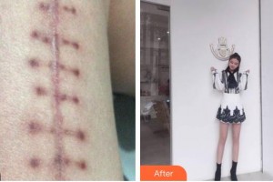 上海港華醫(yī)院浦東分院（悅?cè)葆t(yī)療美容診所）王美華整形價(jià)格表附微創(chuàng)疤痕修復(fù)案例展示