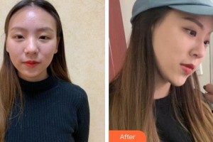 上海美爾雅醫(yī)療美容醫(yī)院趙祐晟整形價(jià)格表附自體肋軟骨隆鼻案例展示