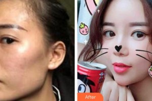 上海瑞東醫(yī)院美容皮膚科王泰然整形價(jià)格表附自體脂肪填充案例展示