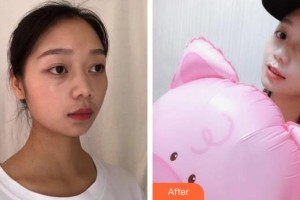 上海首爾麗格醫(yī)療美容醫(yī)院安建榮整形價格表附水氧活膚案例展示