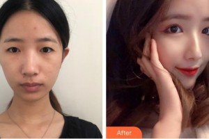 上海亞柏醫(yī)療美容診所徐文龍整形價(jià)格表附美鼻部手術(shù)案例展示