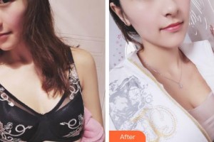 上海明慨醫(yī)療美容門診部慎全祥整形價格表附濃縮豐胸真實案例案例展示