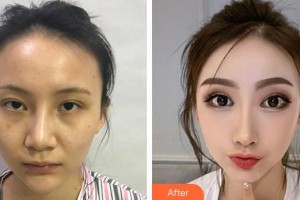 上海鉑曼醫(yī)療美容門診部楊群整形價格表附全切雙眼皮案例展示