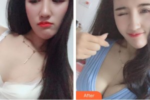 上海明慨醫(yī)療美容門診部張浩杰整形價格表附濃縮豐胸真實案例案例展示