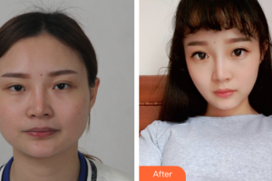 廣州中山醫(yī)博濟(jì)醫(yī)院整形美容中心黎葉整形價格表附DA·頜面整形案例展示