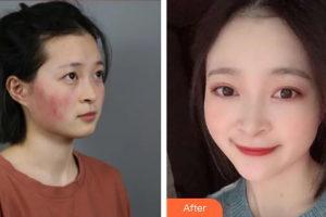 廣州遠(yuǎn)東美容醫(yī)院馮潔整形價格表附微針修復(fù)敏感肌案例展示