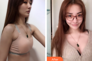 廣州星團(tuán)醫(yī)學(xué)美容門診部祖秉毅整形價格表附濃縮豐胸案例展示