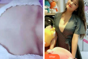 貴陽長江醫(yī)院整形美容中心韓盛斌整形價格表附假體隆胸案例展示