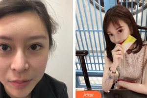 上海明慨醫(yī)療美容門診部楊曉娥整形價格表附假體墊眉弓案例展示