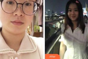 上海鄭逸冰醫(yī)療美容醫(yī)院王秋蓮整形價格表附溶脂案例展示