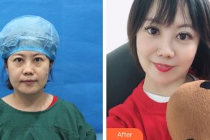 上海百達麗醫(yī)療美容醫(yī)院韓嘉毅整形價格表附不開刀祛眼袋+自體脂肪填充淚案例展示