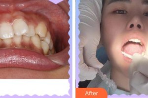 上海百達麗醫(yī)療美容醫(yī)院徐悠游整形價格表附隱形托槽矯正案例展示