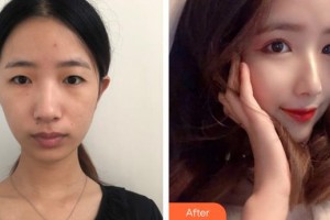 上海華美醫(yī)療美容醫(yī)院張柱允整形價格表附埋線雙眼皮案例展示