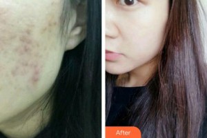 上海美立方整形醫(yī)院王娟整形價格表附微針激光清痘案例展示