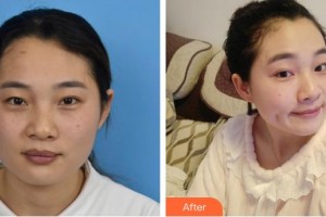 上海美立方整形醫(yī)院迪娃整形價格表附光子嫩膚案例展示