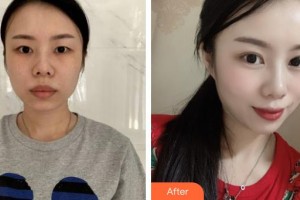 上海宸妃醫(yī)學美容醫(yī)院吳瑪麗整形價格表附埋線雙眼皮案例展示