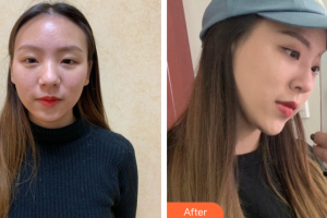 廣州星團(tuán)醫(yī)學(xué)美容門診部田夫整形價格表附自體肋軟骨隆鼻案例展示