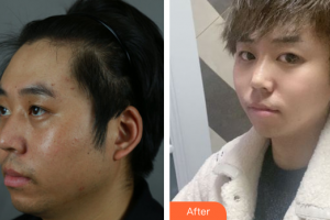 廣州星團(tuán)醫(yī)學(xué)美容門診部劉歡整形價格表附下頜角+皮質(zhì)骨+夾脂墊案例展示