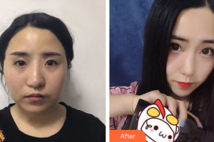 廣州星團(tuán)醫(yī)學(xué)美容門診部張少博整形價格表附面部吸脂案例展示