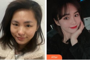 貴陽醫(yī)學(xué)院附屬醫(yī)院燒傷整形外科孔豫蘇整形價格表附眼部綜合案例展示