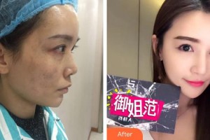 珠海愛思特醫(yī)療美容醫(yī)院李德新整形價格表附鼻部整形案例展示