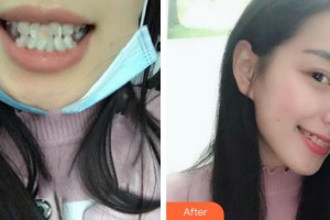 宜昌第二人民醫(yī)院醫(yī)學(xué)美容科謝文勝整形價格表附半隱形牙齒矯正案例展示