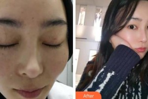 貴陽醫(yī)學(xué)院附屬醫(yī)院燒傷整形外科江濤整形價格表附祛斑案例展示