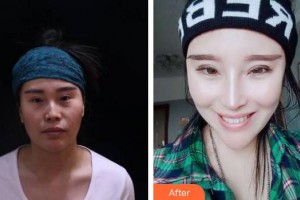 合肥劉大夫美容整形醫(yī)院劉向陽整形價格表附鼻部綜合案例展示