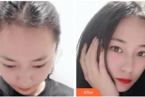 上海韓鏡醫(yī)療美容醫(yī)院魏敬想整形價格表附發(fā)際線種植案例展示