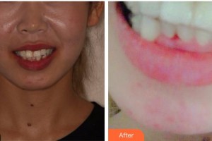 上海紐菲思醫(yī)療美容門診部趙炳澳整形價格表附牙齒隱形矯正案例展示