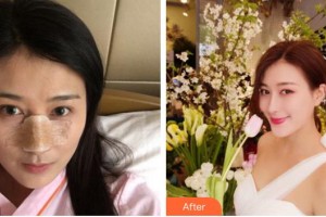 上海馥蘭朵醫(yī)療美容門診部劉小川整形價格表附鼻部手術(shù)案例展示