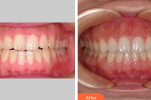 上海維佳康口腔醫(yī)院余玉祥整形價格表附隱形矯正案例展示