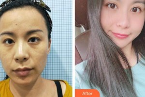 上海明潭眼科門診部王素羽整形價格表附眼部手術(shù)案例展示