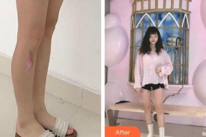 上海長江醫(yī)院李惠芬整形價格表附增生疤痕案例展示